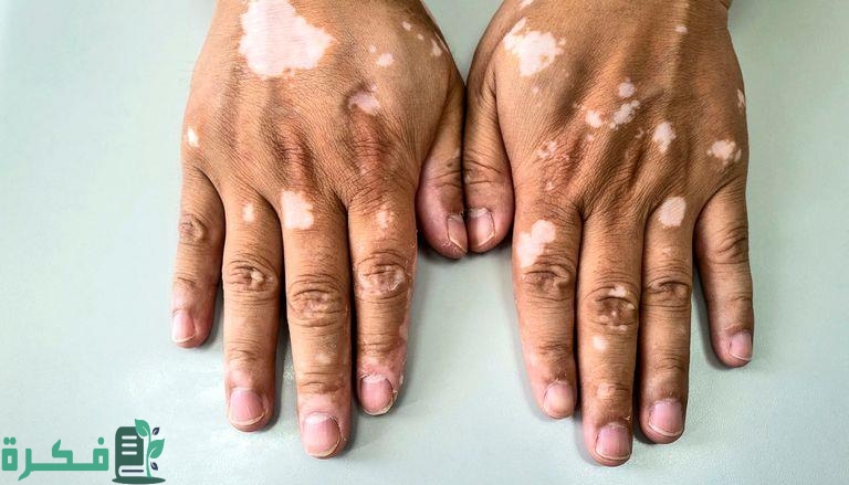 أسماء الأطعمة التي يجب تناولها للتخلص من البهاق 2 الأطعمة التي يجب تناولها للتخلص من البهاق