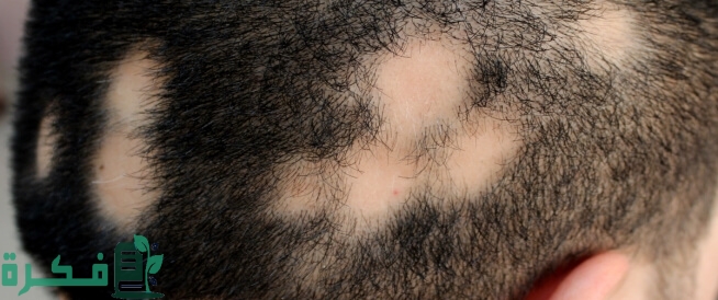 الفرق بين الثعلبة وفراغات الشعر