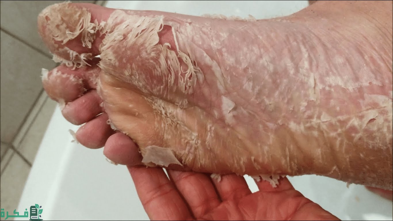 خلطات طبيعية لإزالة الجلد الميت والحصول على قدم ناعمة