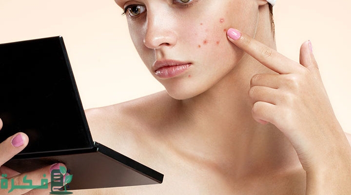 طرق منزلية للتخلص من حب الشباب الهرموني