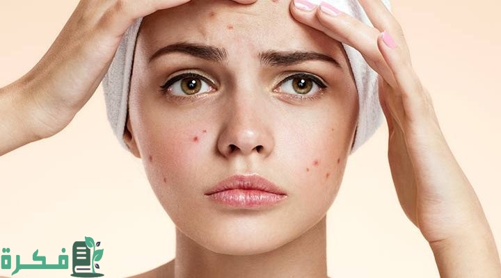 طريقة علاج حبوب القيح في الوجه