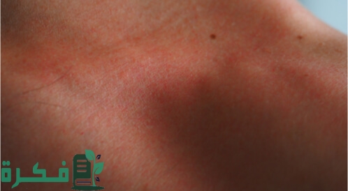 علاج التسلخات بين الفخدين في المنزل