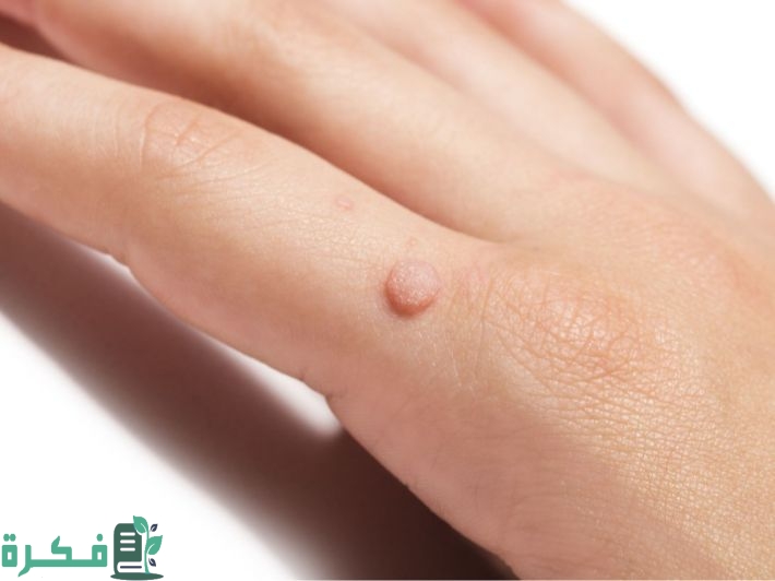 علاج الثالول بمعجون الأسنان