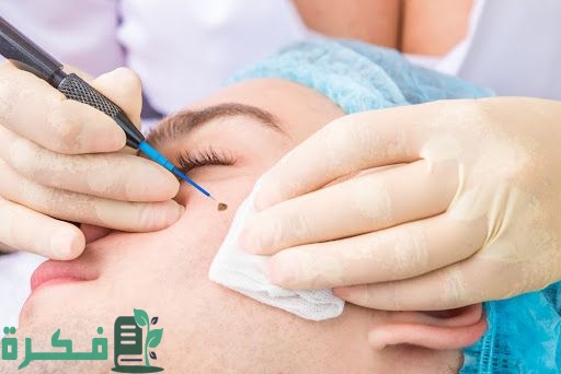 كيفية التخلص من الشامات المسطحة