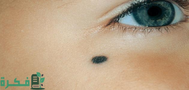 أنواع الشامات