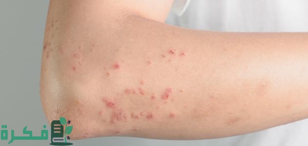 علاج حساسية الجلد من الكلاب