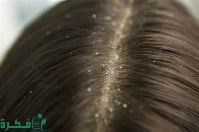 هل يفقس بيض القمل خارج الشعر 1 هل يفقس بيض القمل خارج الشعر؟