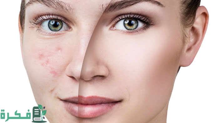 إزالة آثار حب الشباب والبقع الغامقة من الوجه