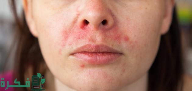 علاج حساسية الجلد من الصبغة السوداء