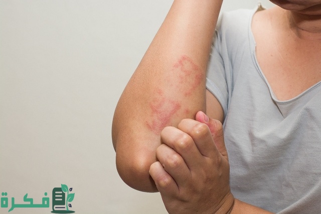 علاج حساسية الجلد من الملح