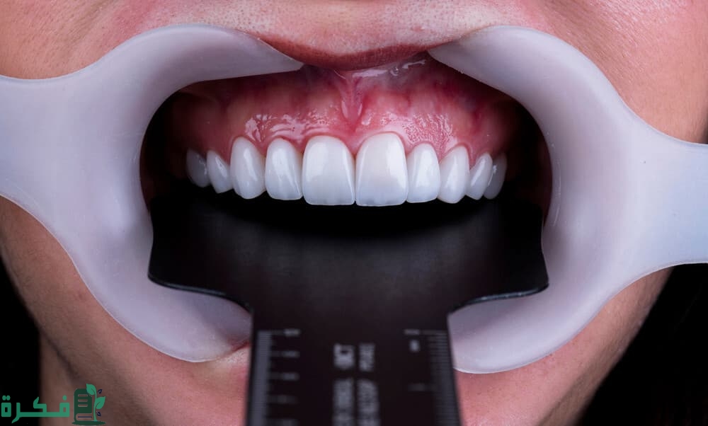 كم سعر ابتسامة هوليود في مصر