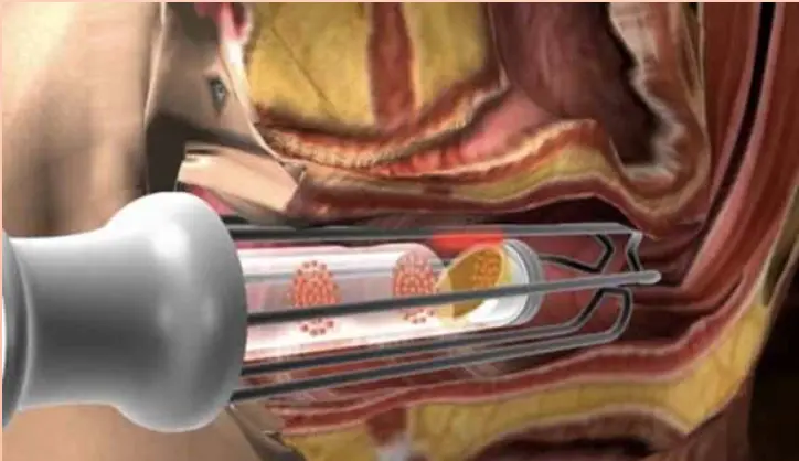 تجربتي مع عملية تضييق المهبل جراحيًا