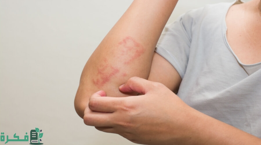 ما أسباب ظهور حبوب في اليدين والرجلين عند الأطفال