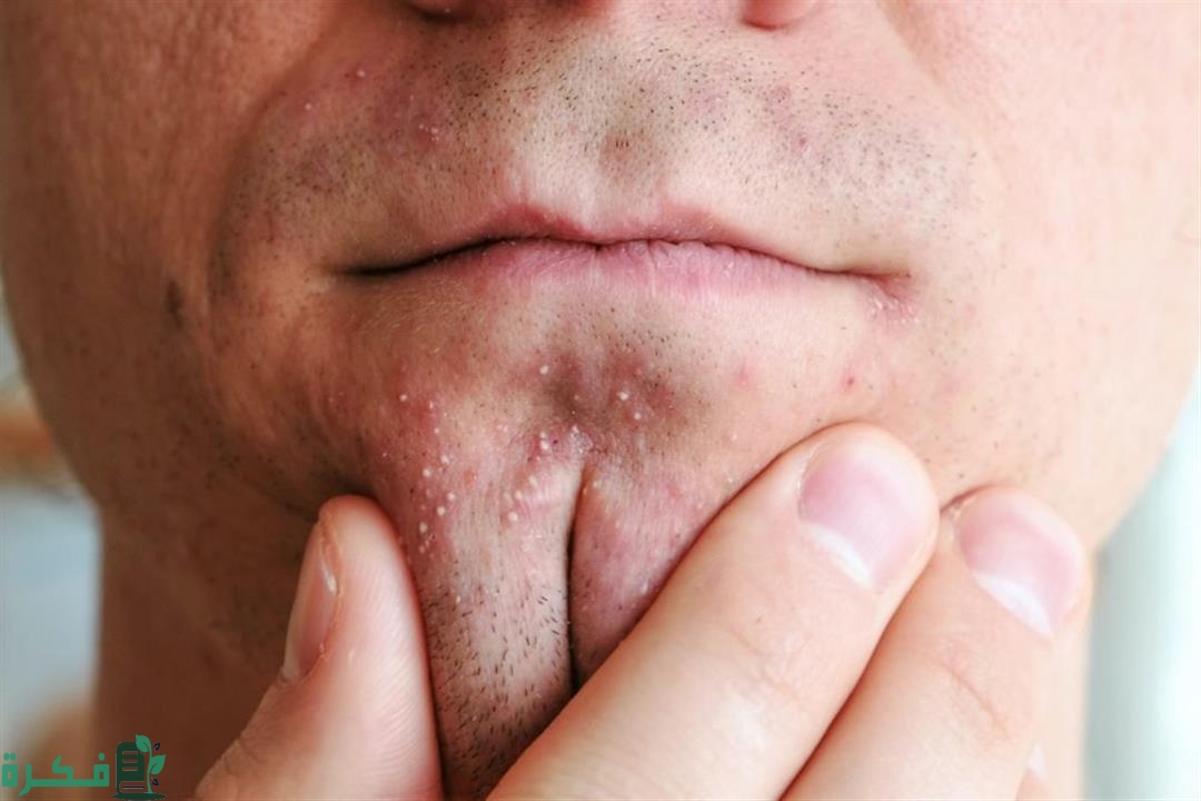 هل هناك علاقة بين ظهور الحبوب وممارسة الجنس 5 هل هناك علاقة بين ظهور الحبوب وممارسة الجنس