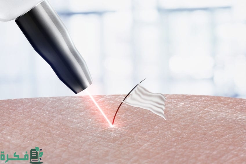 اذا طلع الشعر بعد الليزر كيف اشيله