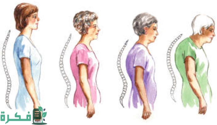 أنواع تقوس الظهر بالصور