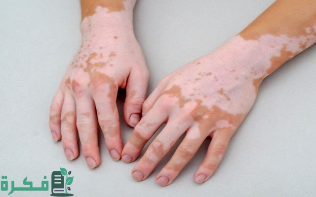 هل البهاق يمنع من دخول العسكرية السعودية