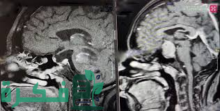 مستشفى الدكتور سليمان الحبيب بالفيحاء في جدة يستأصل ورماً بالبروستاتا بتقنية Hollep الحديثة وبتخدير جزئي