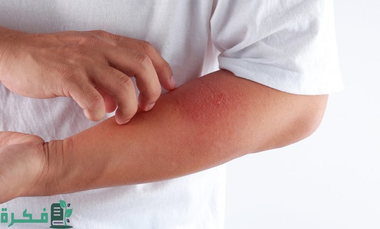 4 نصائح للوقاية من التسلخات الجلدية بسبب الحرارة والمشي أثناء الحج يبرزها "صحي القصيم"