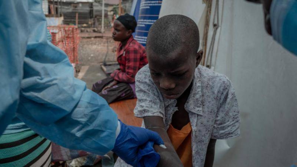 غينيا تسجل زيادة ملحوظة في حالات الإصابة بجدري القردة