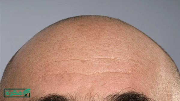 وداعا لعمليات زرع الشعر.. طريقتين فعالتين لمكافحة الصلع
