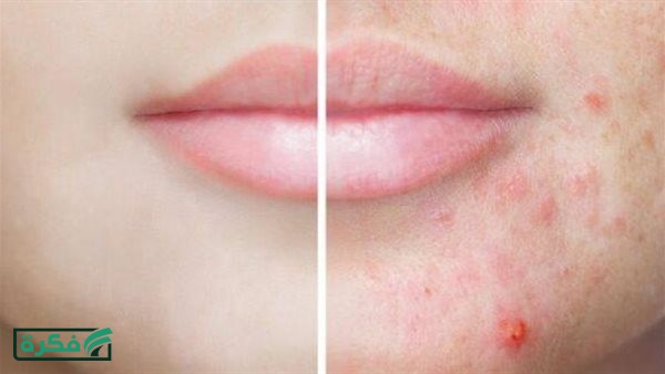 وصفة لحبوب الوجه.. خطوات طبيعية لبشرة صافية ومشرقة